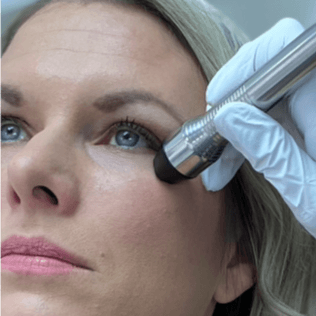 RF Eye Firming Pack of 4 at SkinFix Pro in Longwood, FL